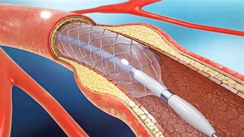 OmniCure S2000 Elite Supports 360° Bonding in Cardiovascular Catheter Manufacturing